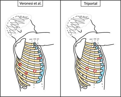A real-world experience of transition to robotic-assisted thoracic surgery (RATS) for lung resections